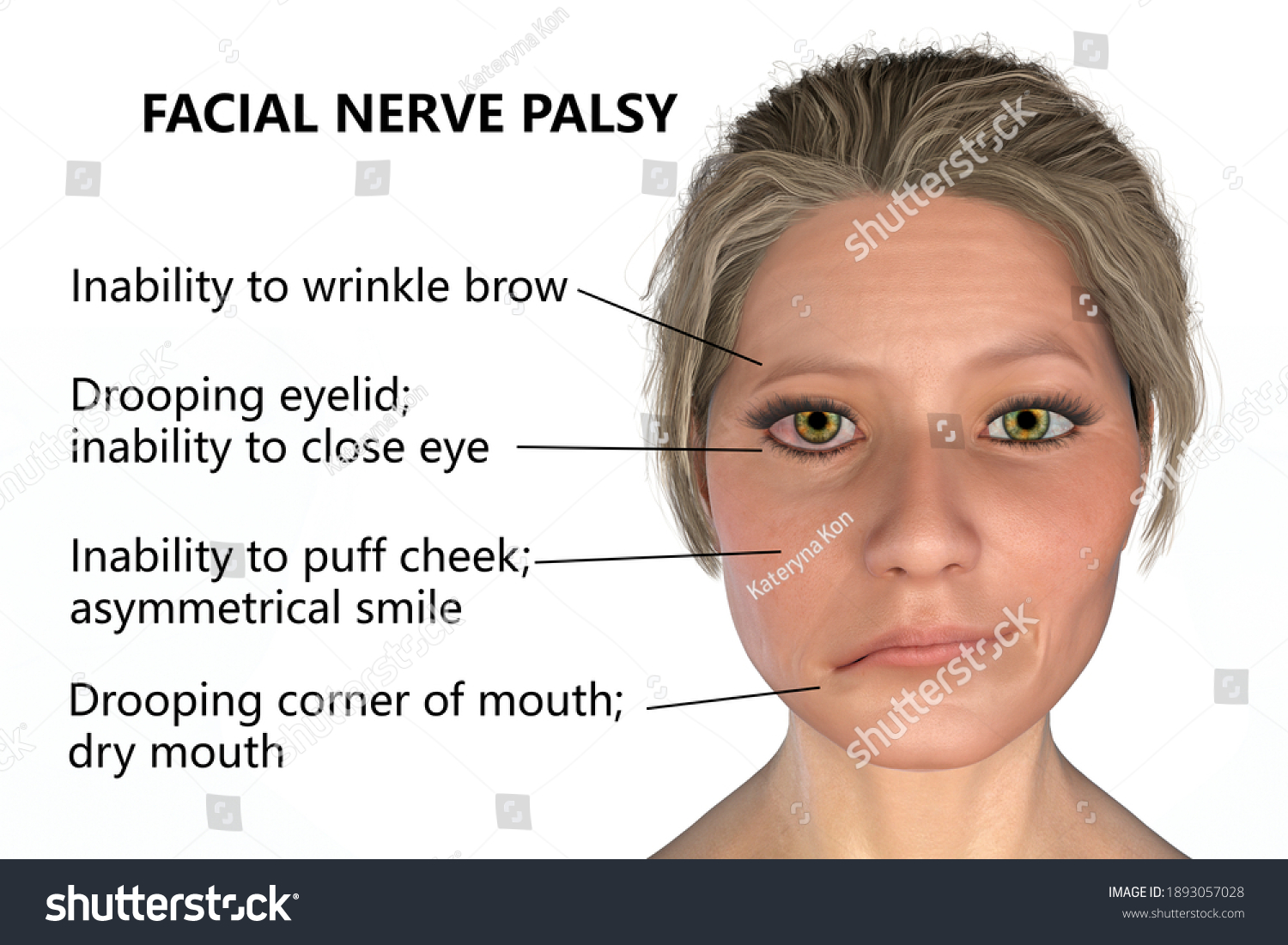 Facial Nerve Paralysis Bells Palsy 3d ilustrações stock 1893057028