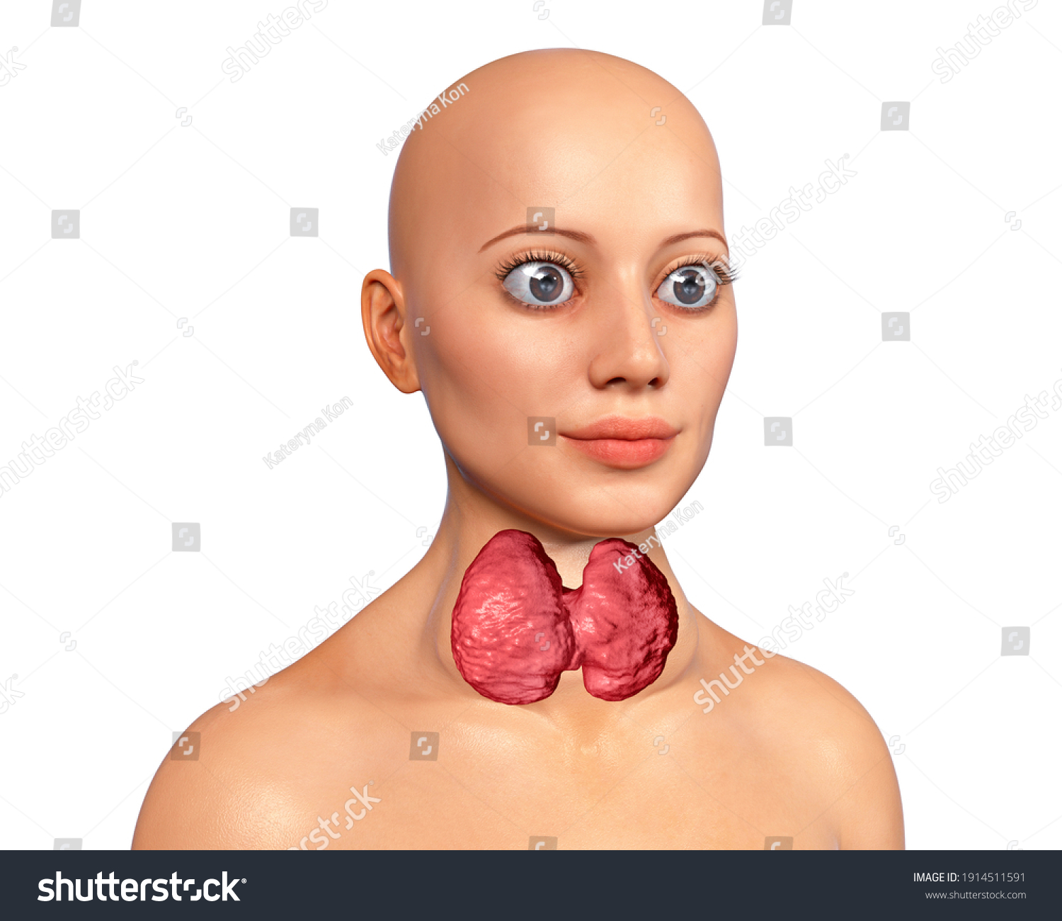 Hyperthyroidism 3d Illustration Showing Enlarged Thyroid Stock