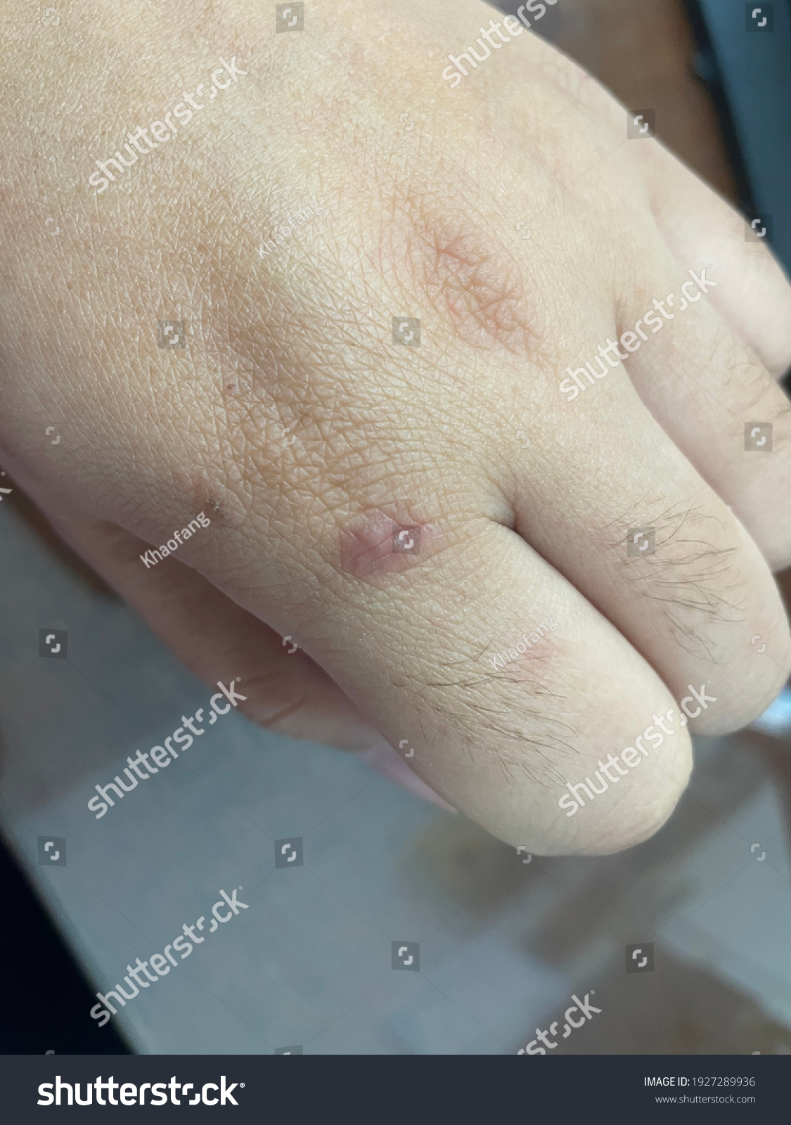 Dyshidrosis Dyshidrotic Eczema Pompholyx Endrogenous Dermatitis Foto