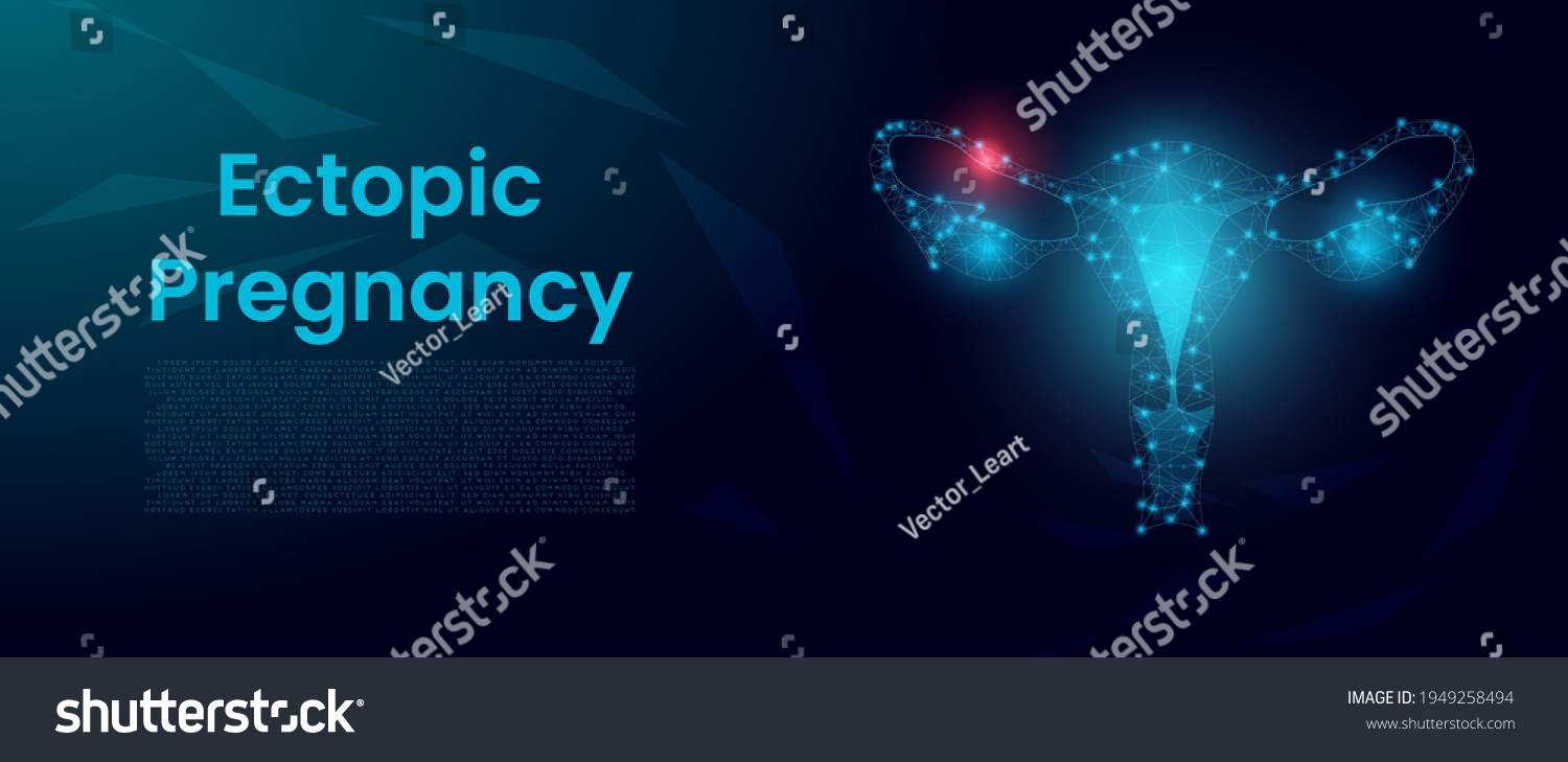 Ectopic Pregnancy Concept Female Reproductive System เวกเตอรสตอก
