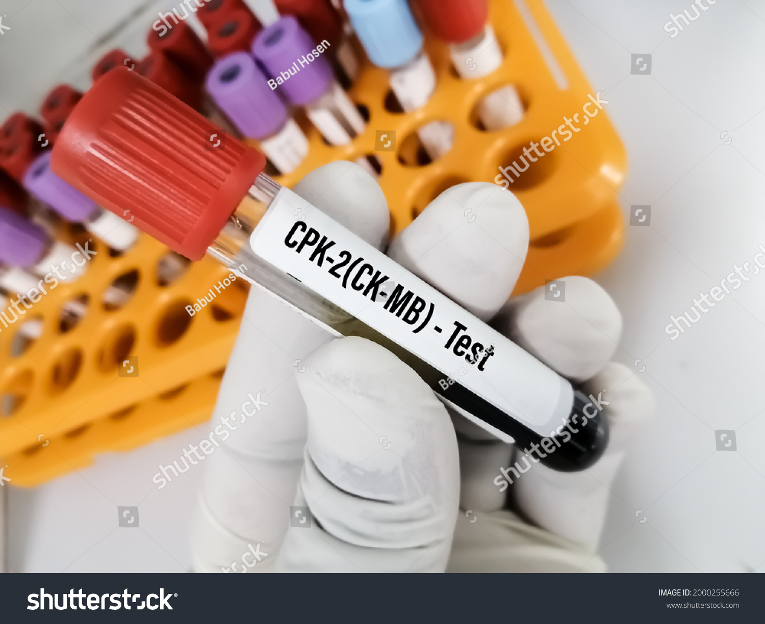 Blood Sample Creatine Phosphokinase Cpk Enzyme Stock Photo