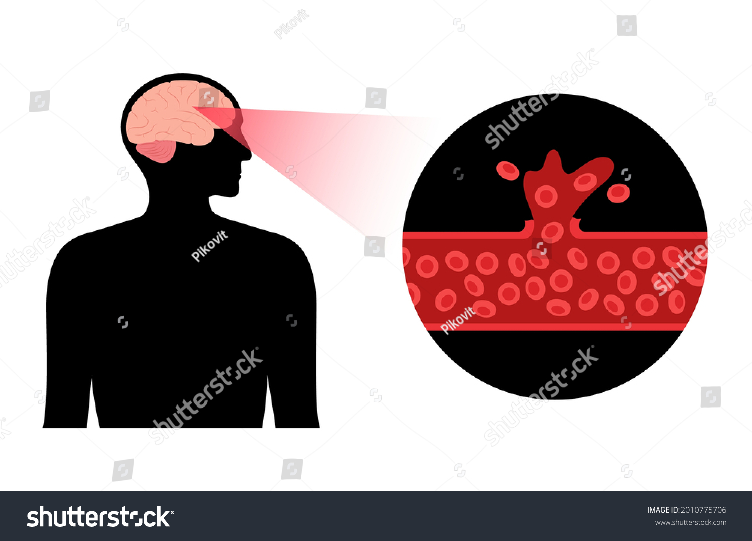 Hemorrhagic Brain Stroke Concept Apoplexy Cerebral Stock Vector