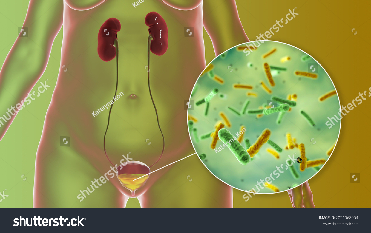 Cystitis Bacterial Infection Urinary Bladder Conceptual Stock