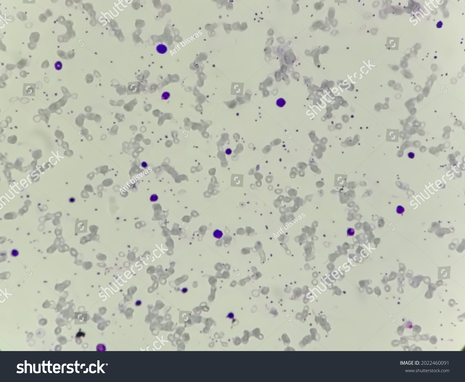 Blood Film Microscopic View Cold Agglutinin Stock Photo 2022460091