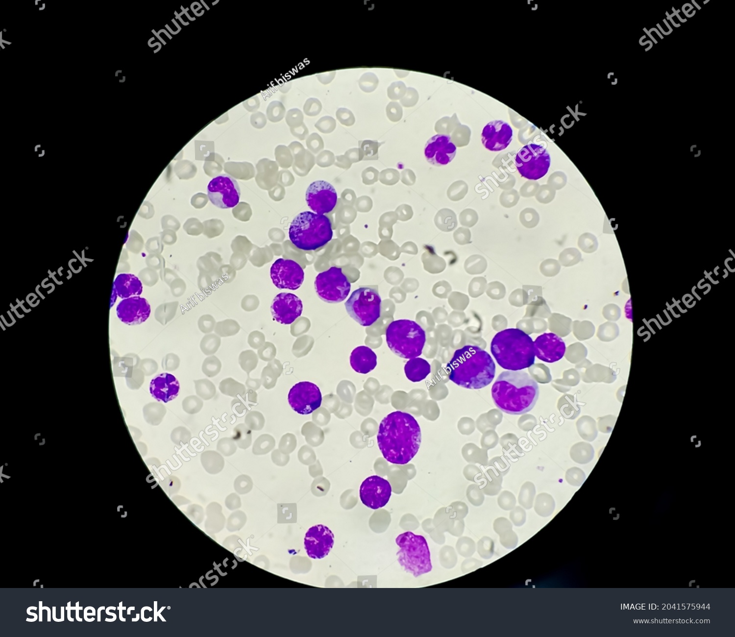 Blood Smear Under Microscopy Showing Chronic Stock Photo