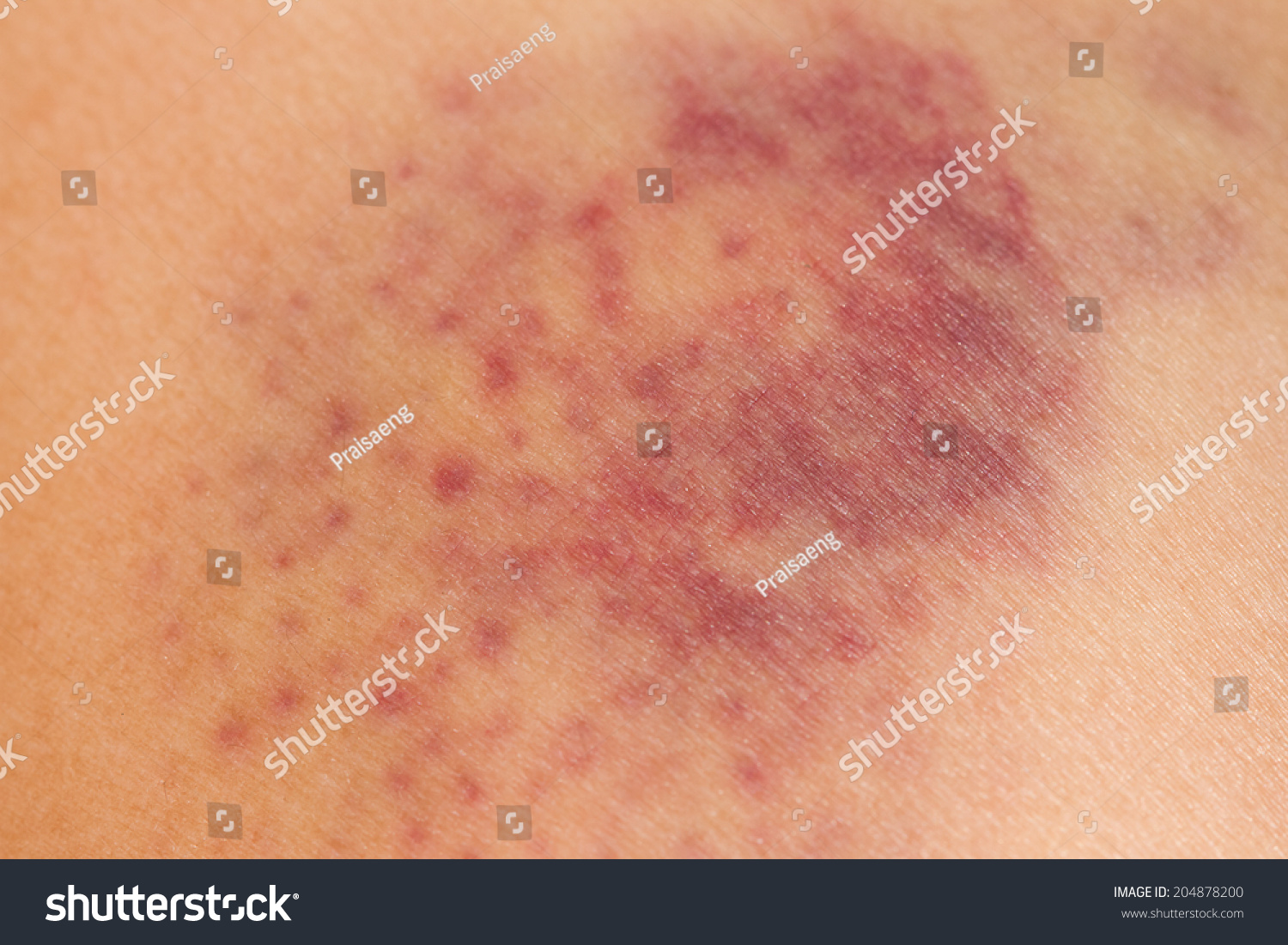 Closeup Bruise On Wounded Womans Leg Stock Photo 204878200 Shutterstock