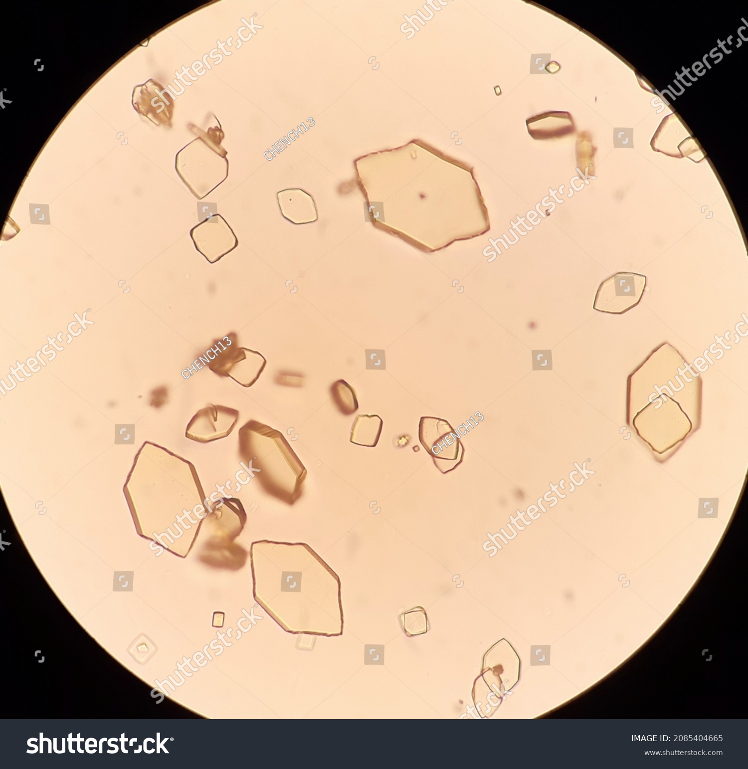 Uric Acid Crystals Urine Analysis Stock Photo Shutterstock