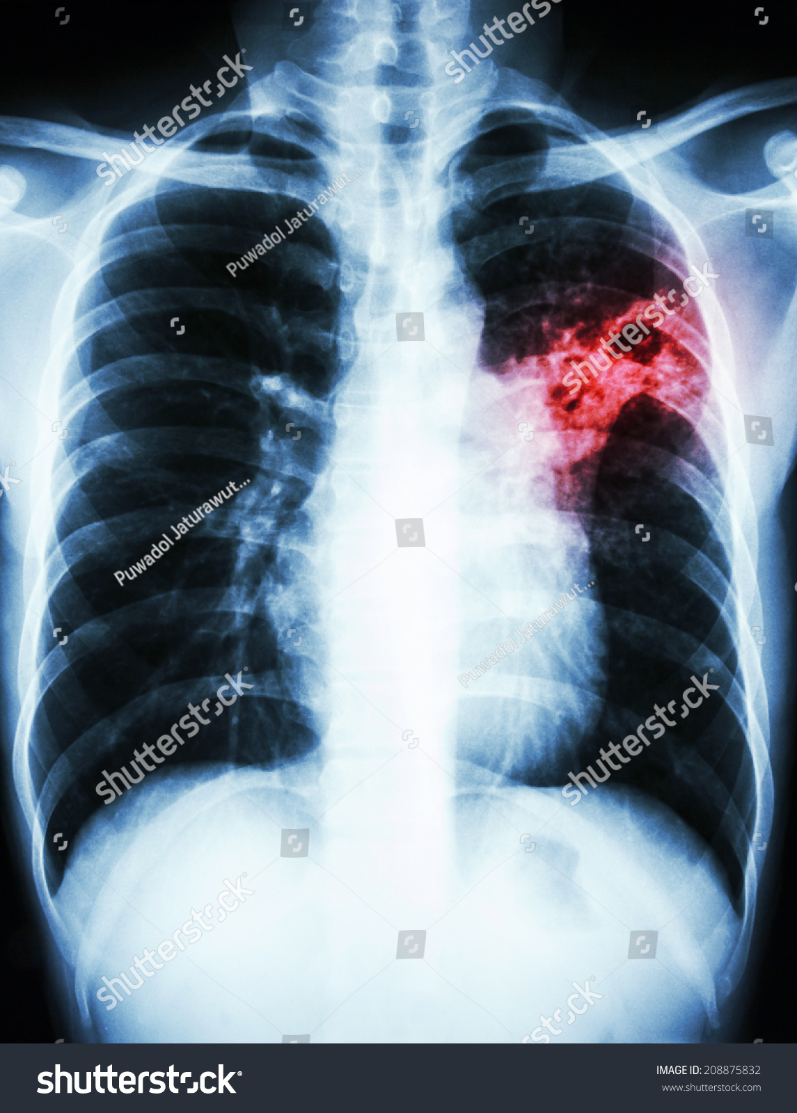 Film Chest Xray Show Alveolar Infiltrate Stock Photo 208875832