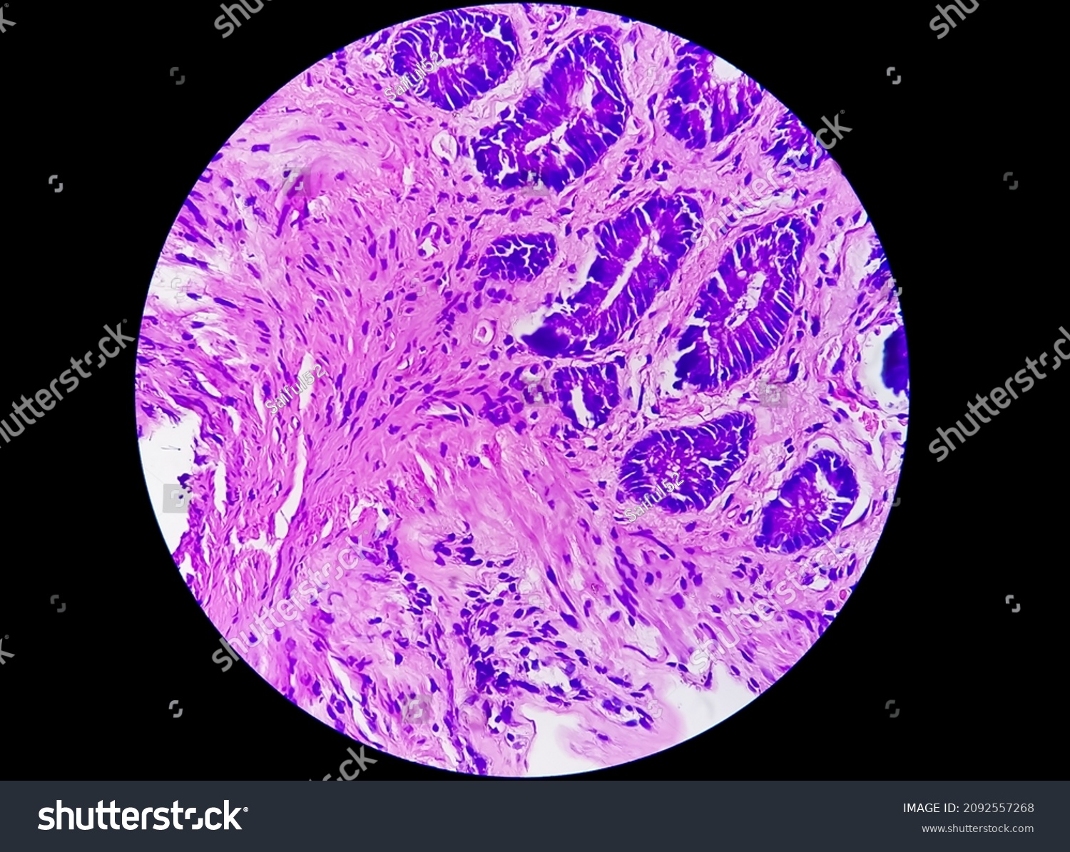 Photomicrograph Colon Biopsy Obtained During Colonoscopy Stock Photo