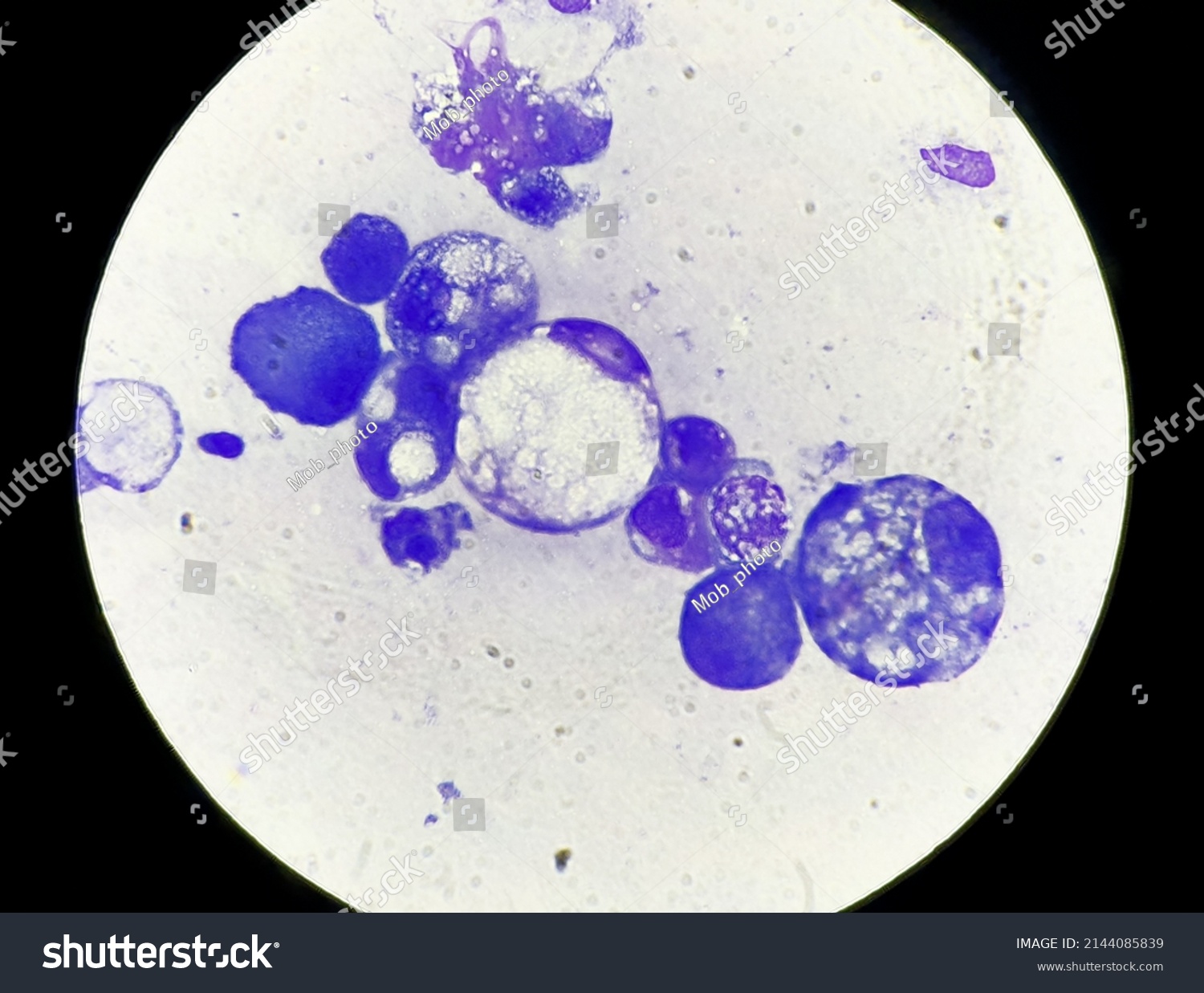 Zdj Cie Stockowe Atypical Cells Pleural Effusion Smears Stained