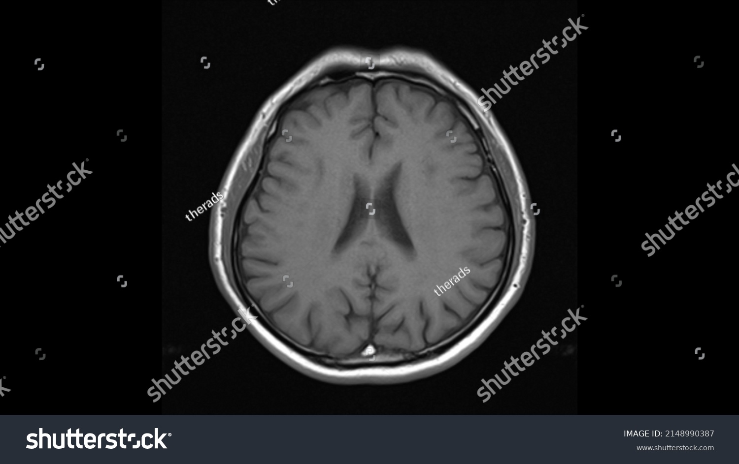 Normal Brain Anatomy Axial T Weighted Mri Stock Photo