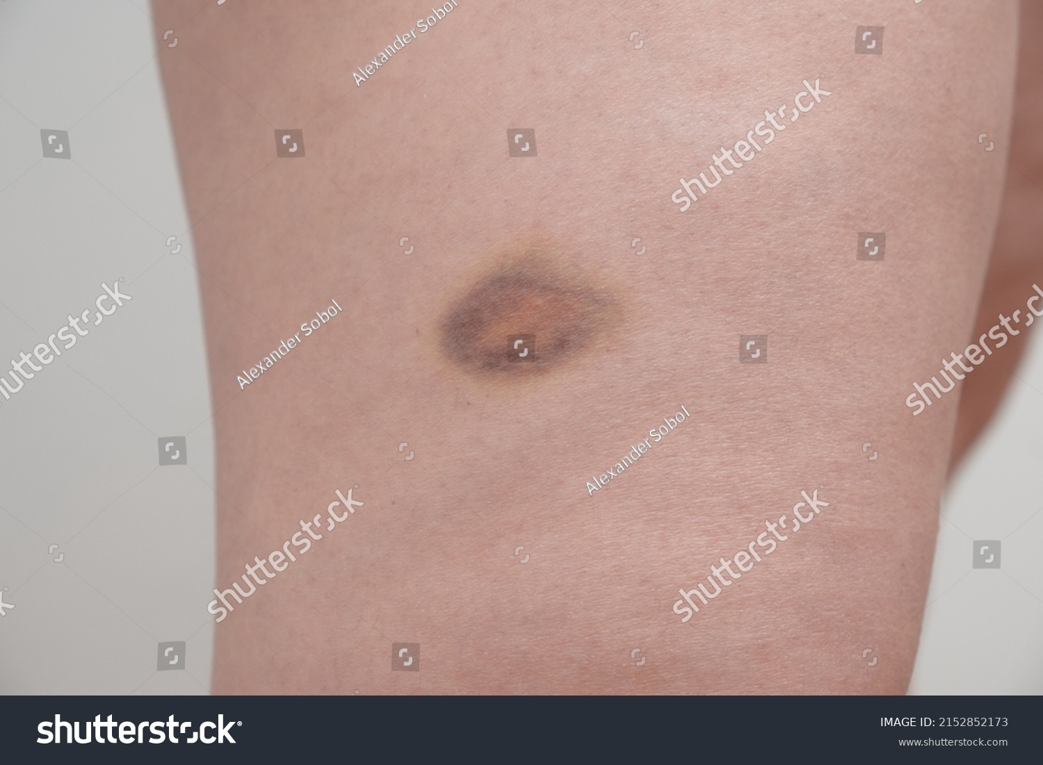 Bruise On Girls Leg Hematoma After Stock Photo 2152852173 Shutterstock