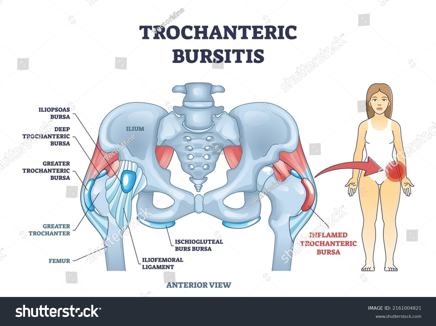 Trochanteric Bursitis Bursa Inflammation Located Hip Stock Vector Royalty Free