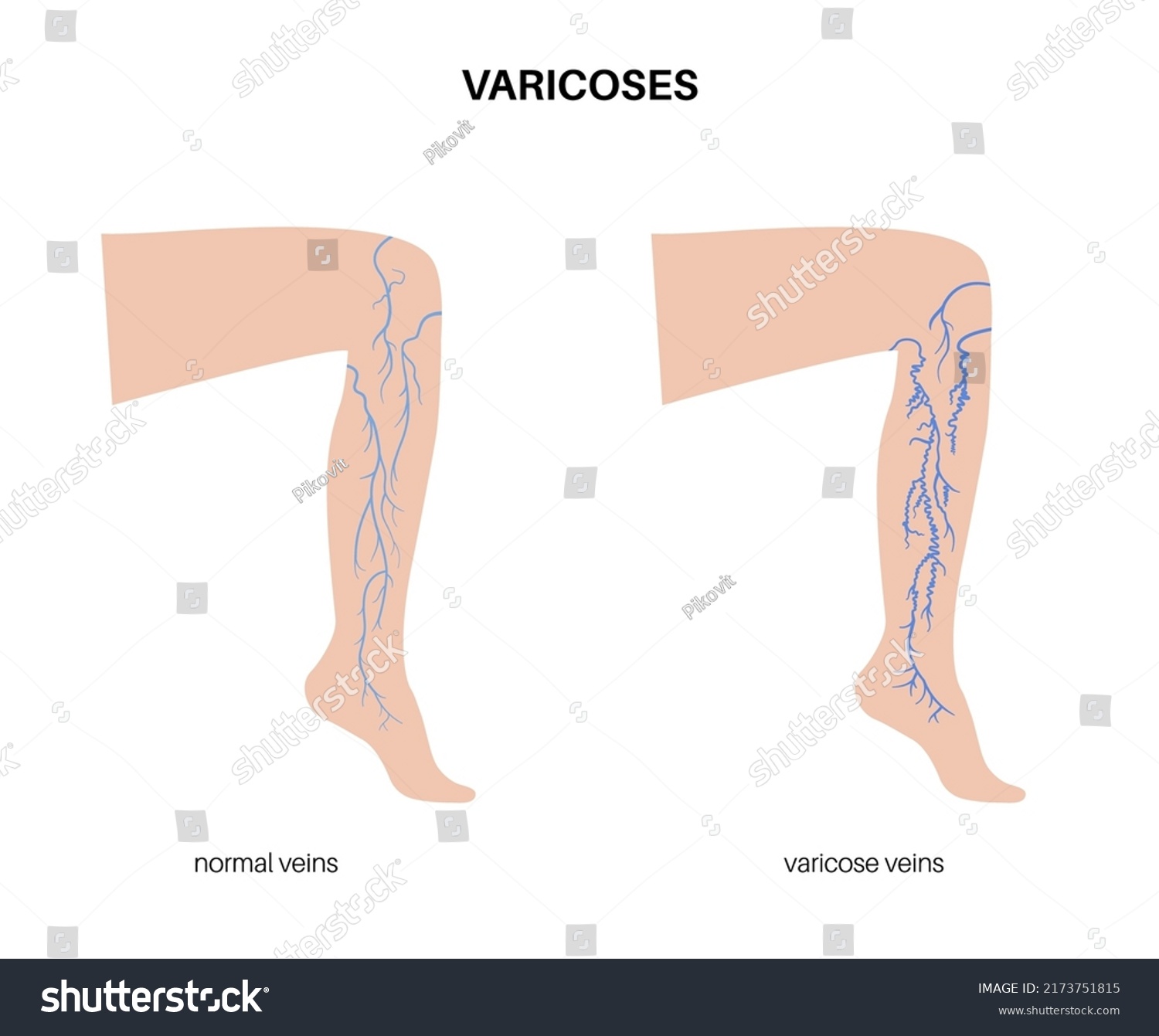 Varicose Veins Concept Swelling Pain Female Stock Vector Royalty Free