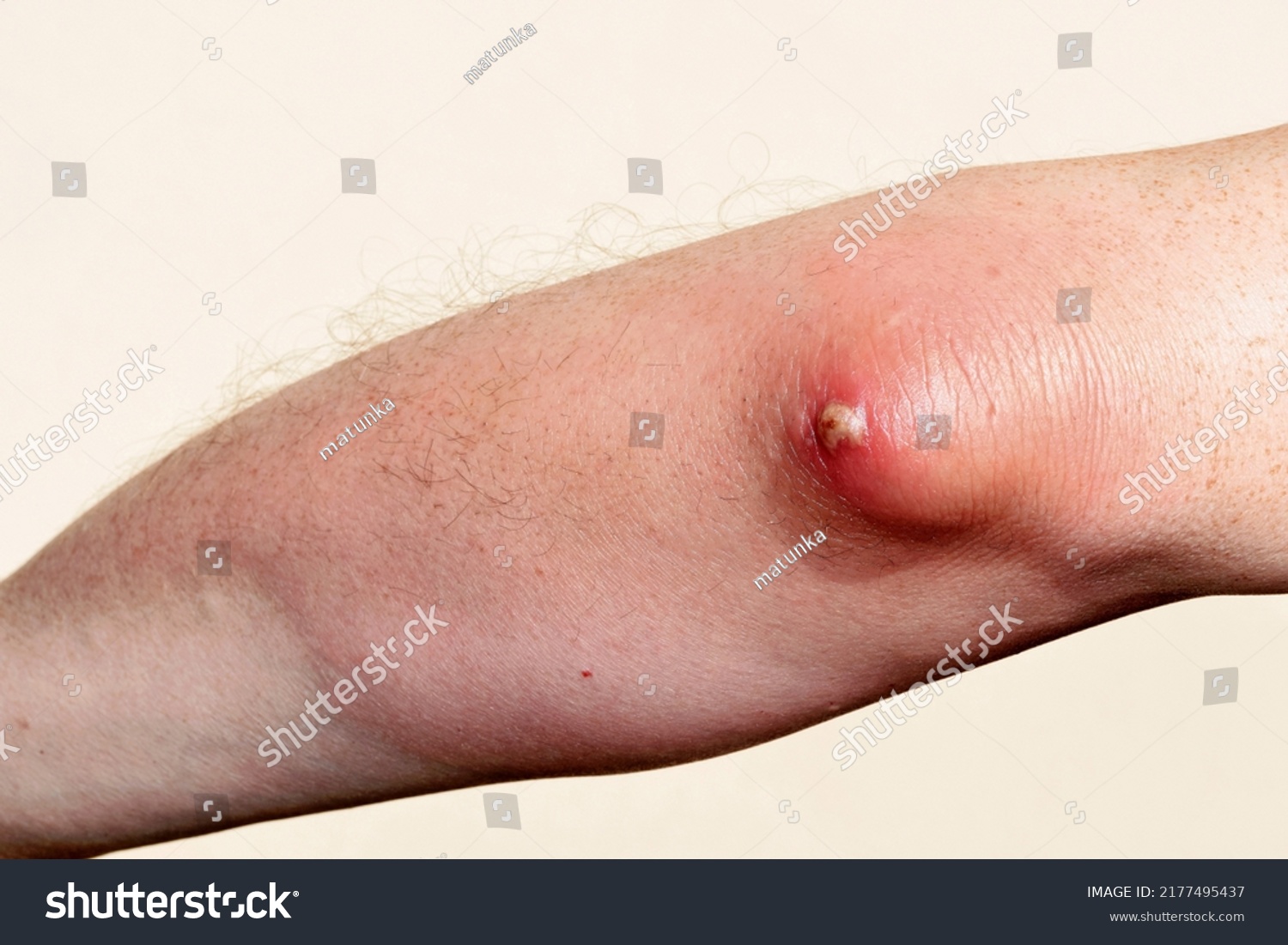 Olecranon Bursitis Abscess Elbow Inflammation Infection Stock Photo