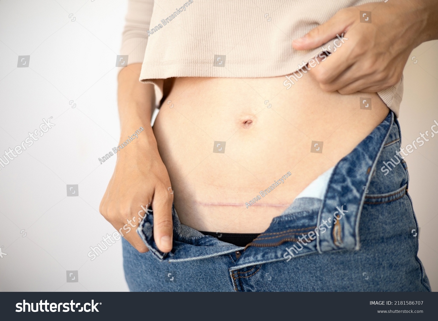 Close Moms Abdomen After Cesarean Section Stock Photo 2181586707