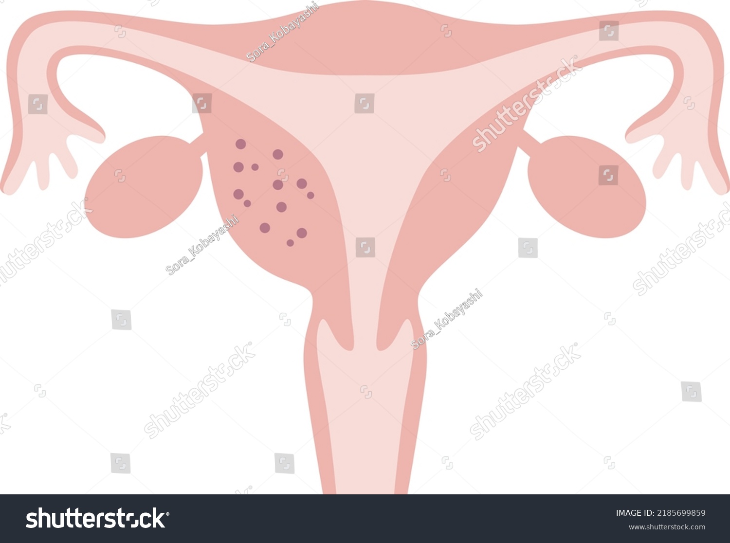 Illustration Adenomyosis Uterus That Occurred Part Stock Vector