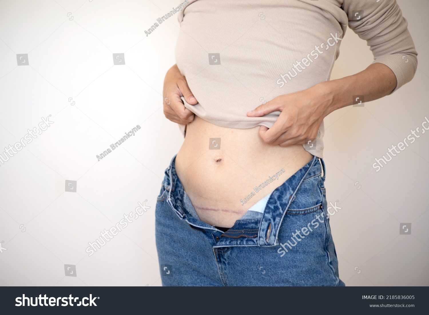 Close Moms Abdomen After Cesarean Section Stock Photo 2185836005