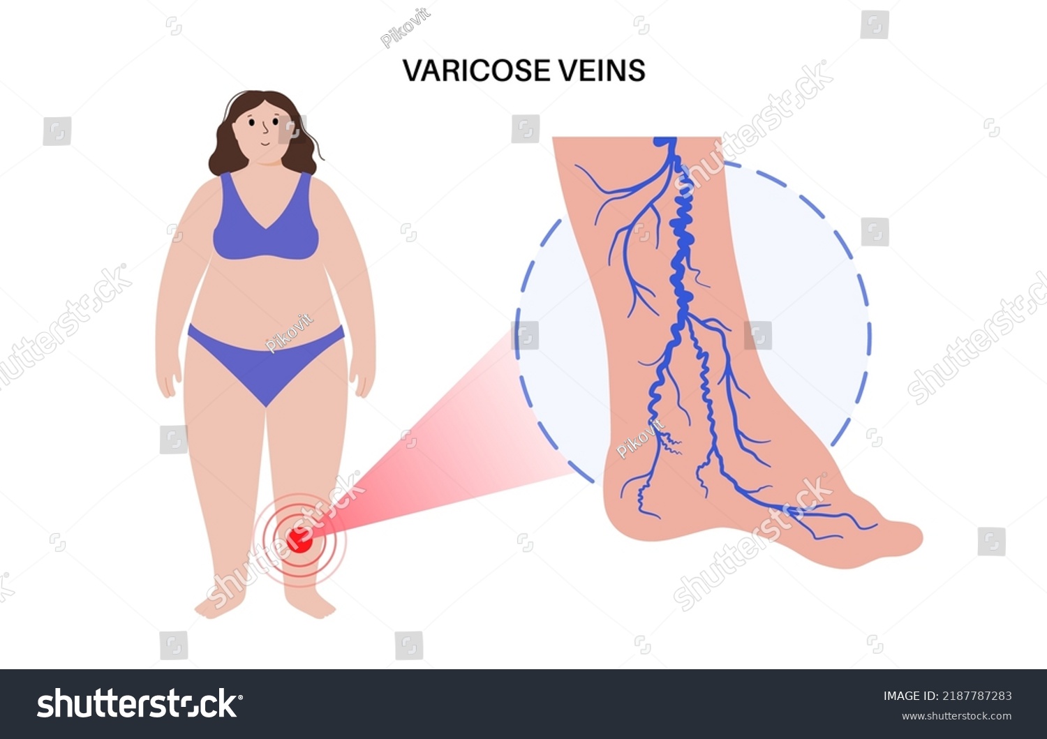 Varicose Veins Concept Swelling Pain Human Stock Vector Royalty Free