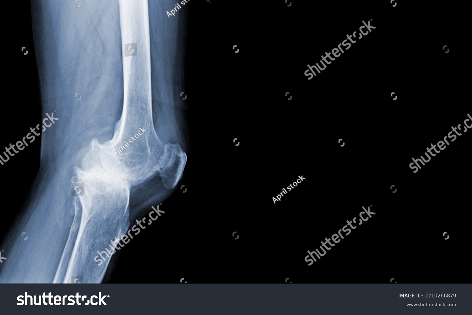 Film Xray Human Knee Severe Osteoarthritis Stock Photo