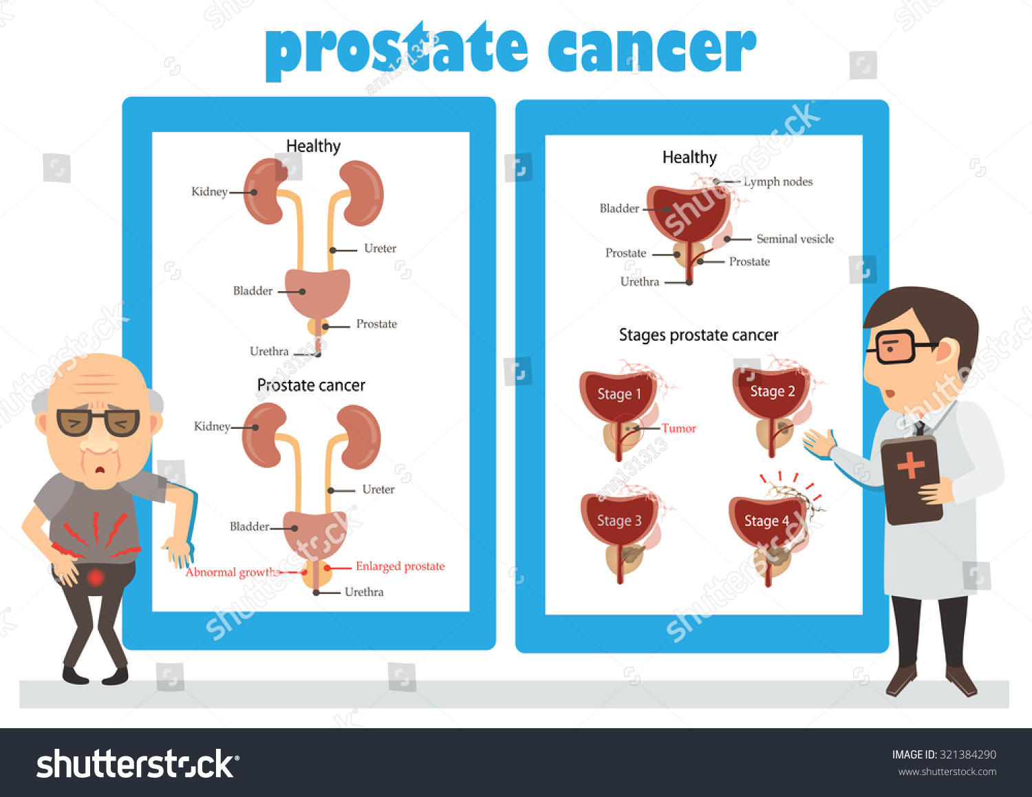 Stages Prostate Cancer Cancer Consultation Man Stock Vector Royalty