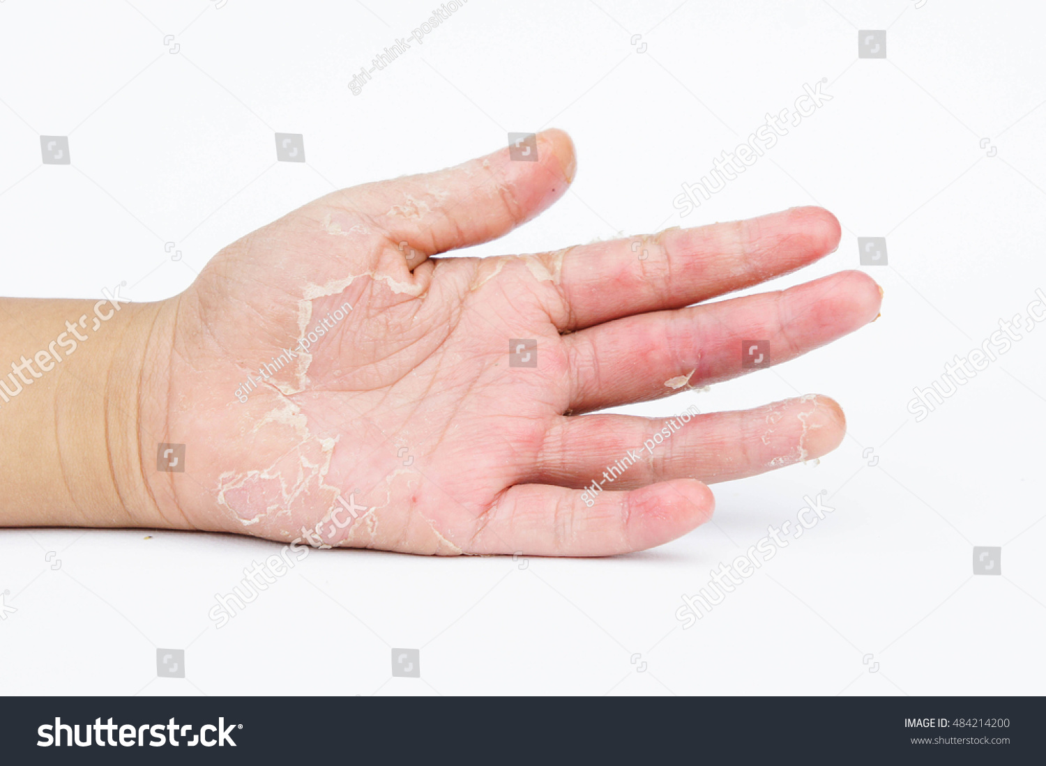 Dry Hands Peel Contact Dermatitis Fungal Stock Photo 484214200