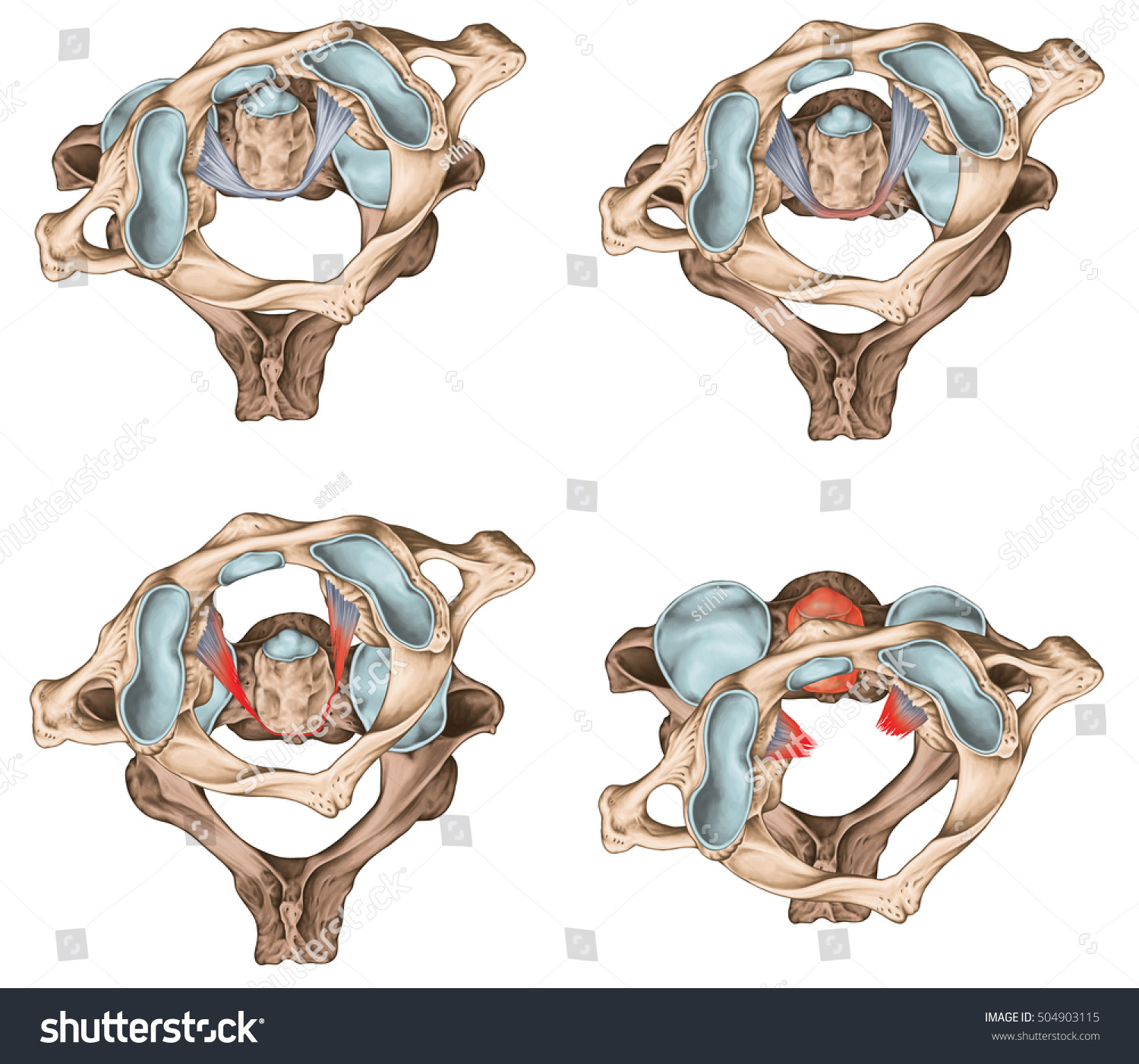 Traumatic Rotatory Displacement Atlas Subluxation Dislocation