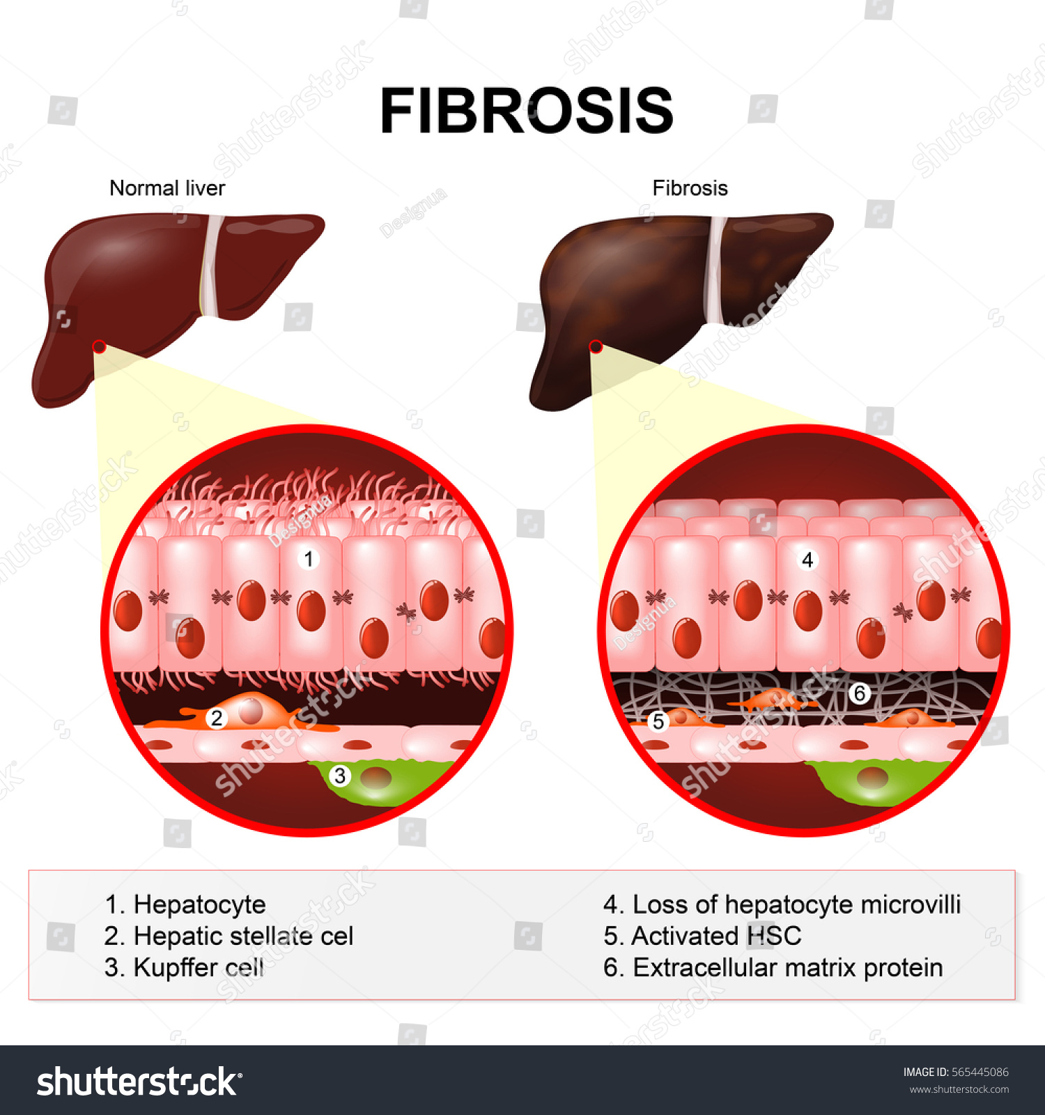 Liver Fibrosis Cirrhosis Human Liver Diseases