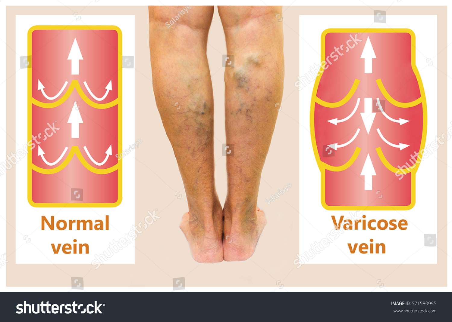 Варикоз Фото Cream Of Varicose Veins