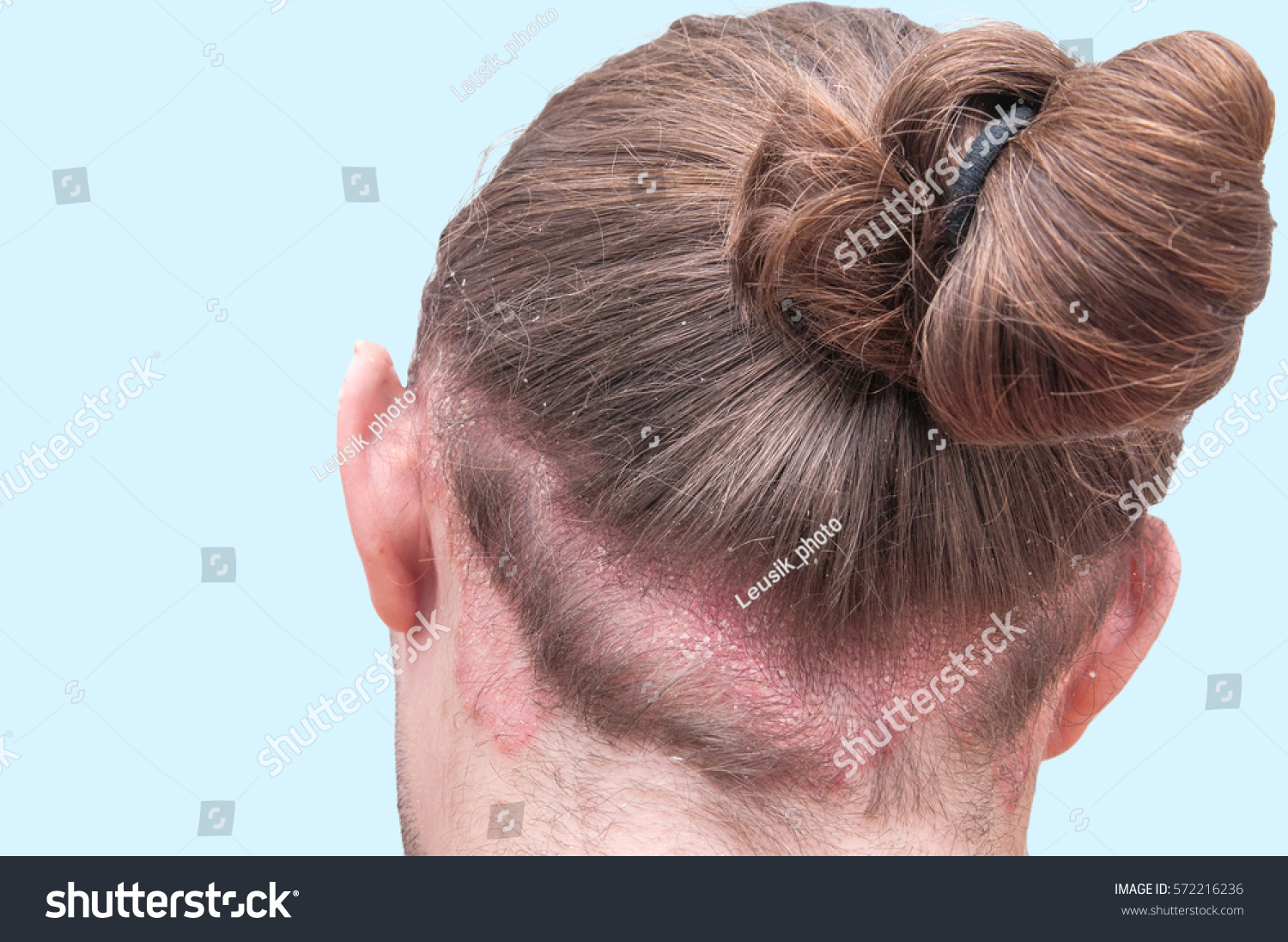 Red Psoraitic Spot On Hairline Dermatological Stock Photo Shutterstock