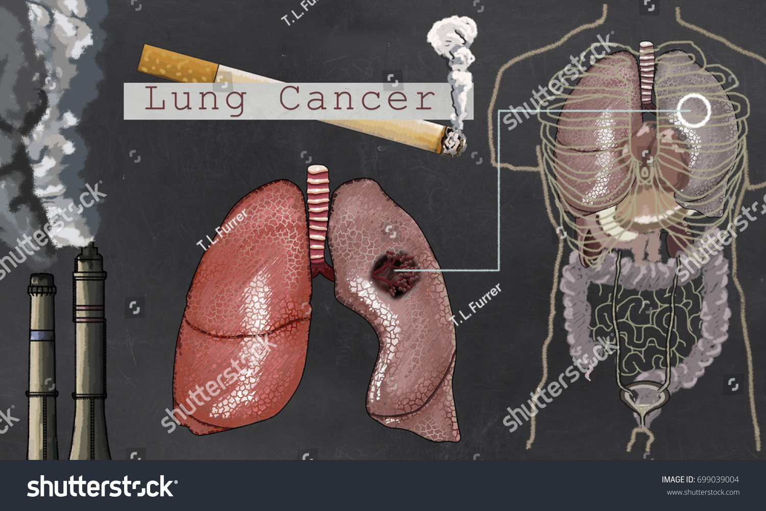 Cigarette Smoking Lung Cancer