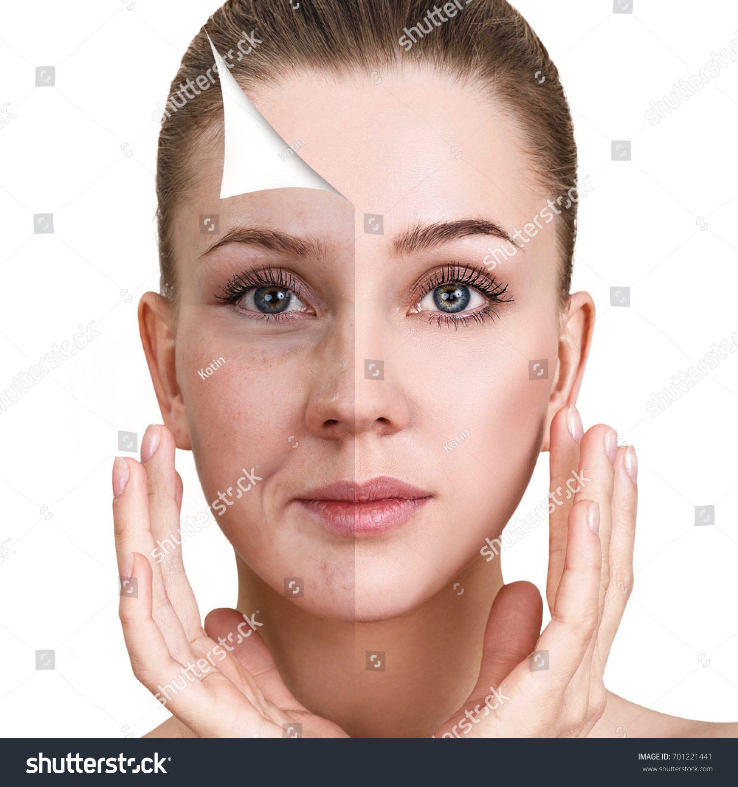 Womans Face Before After Rejuvenation Stock Photo Shutterstock