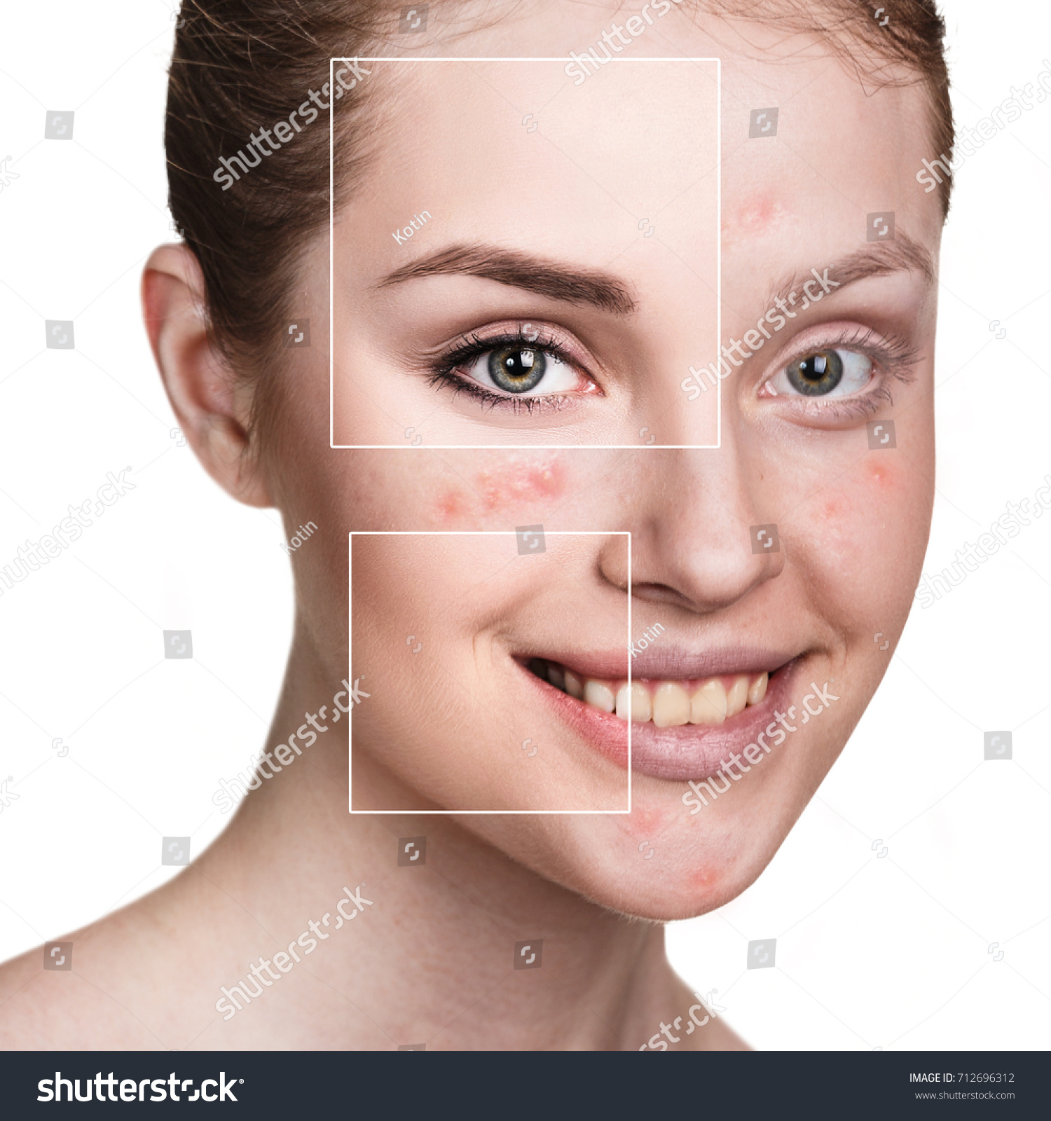 Womans Face Before After Treatment Stock Photo Shutterstock