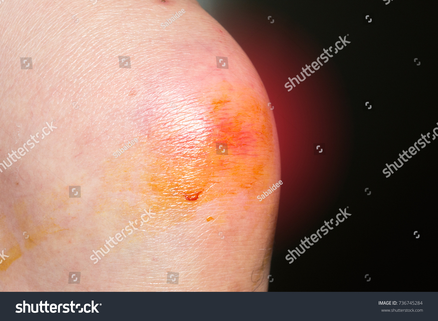 Bruised Wound Injury On Knee Stock Photo 736745284 Shutterstock