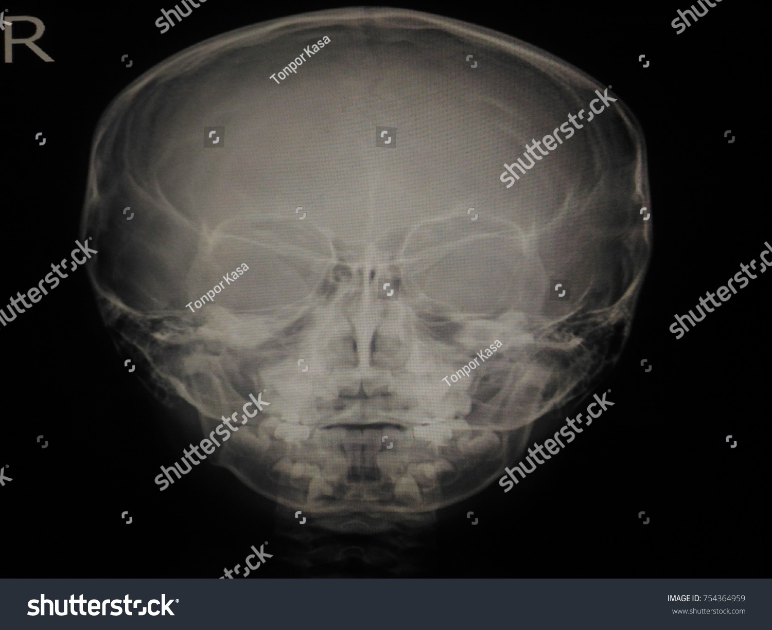 Sinusitis Film Xray Skull Ap Anterior Stock Photo Shutterstock