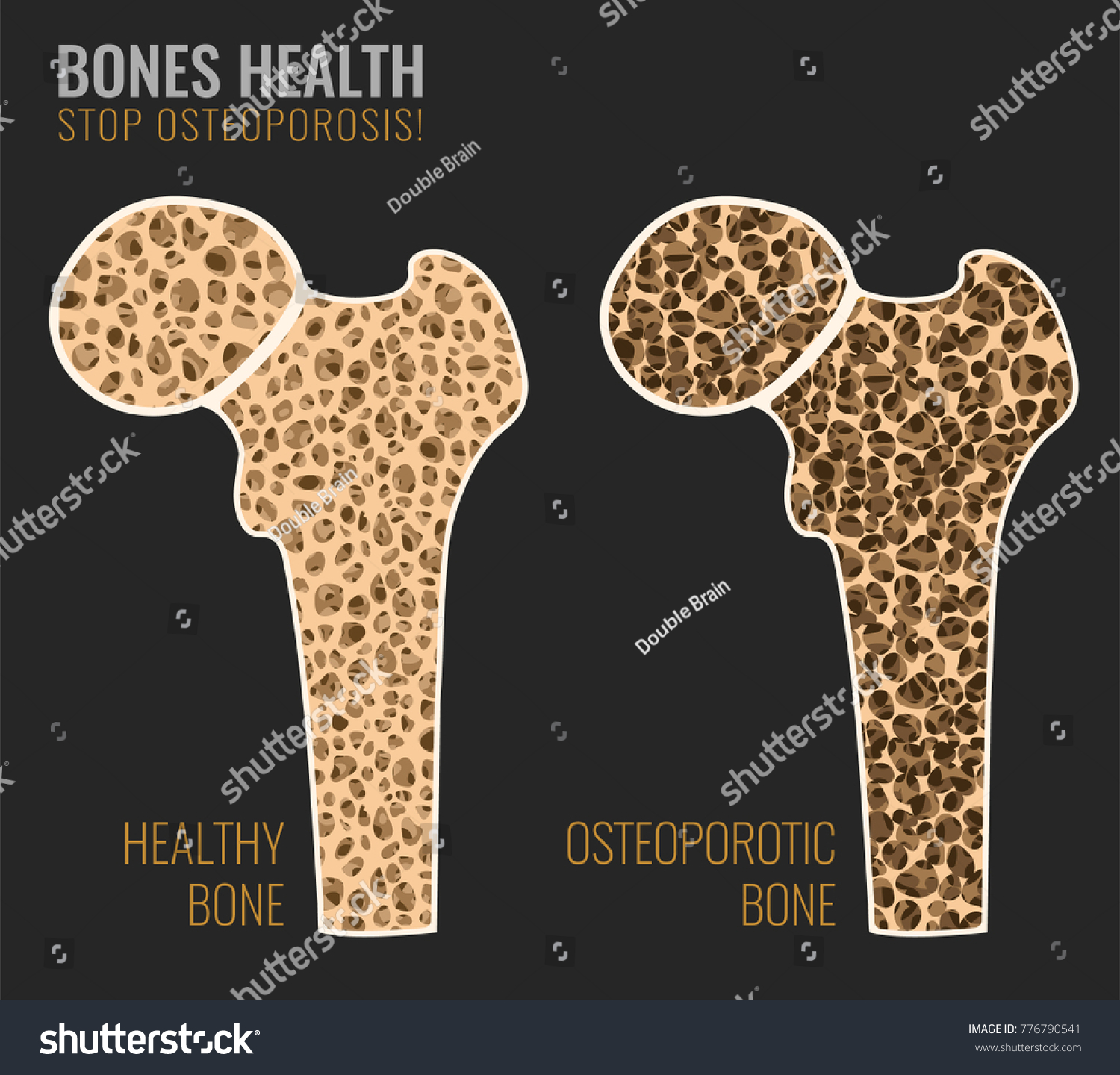 Osteoporosis Cross Section Image Osteoporosis Bone