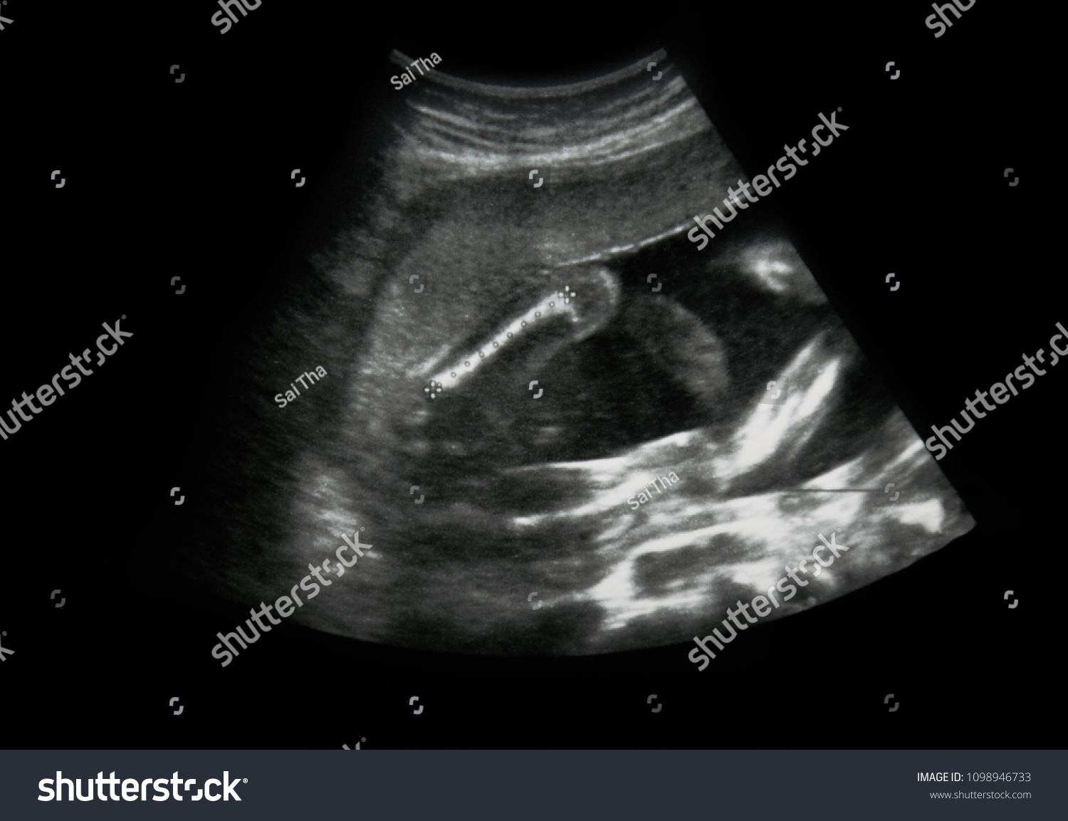 Ultrasound Of Baby In Mother S Womb Royalty Free Stock Photo