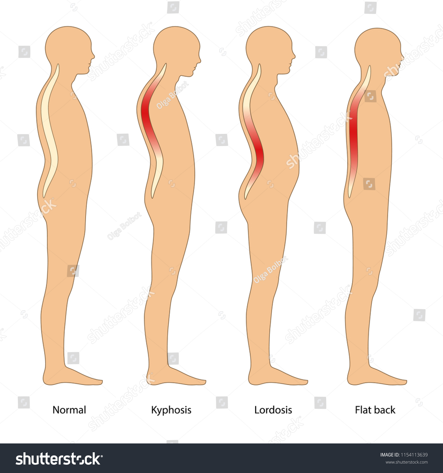 Spinal Deformity Types Lateral View Vector Royalty Free Stock