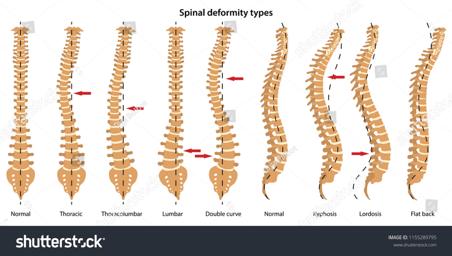 Spinal Deformity Types Anterior View And Royalty Free Stock Vector