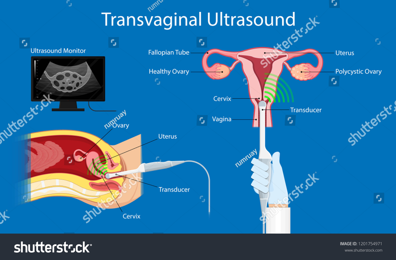 Polycystic Ovary Syndrome Pcos Hormonal Diagnose Royalty Free Stock