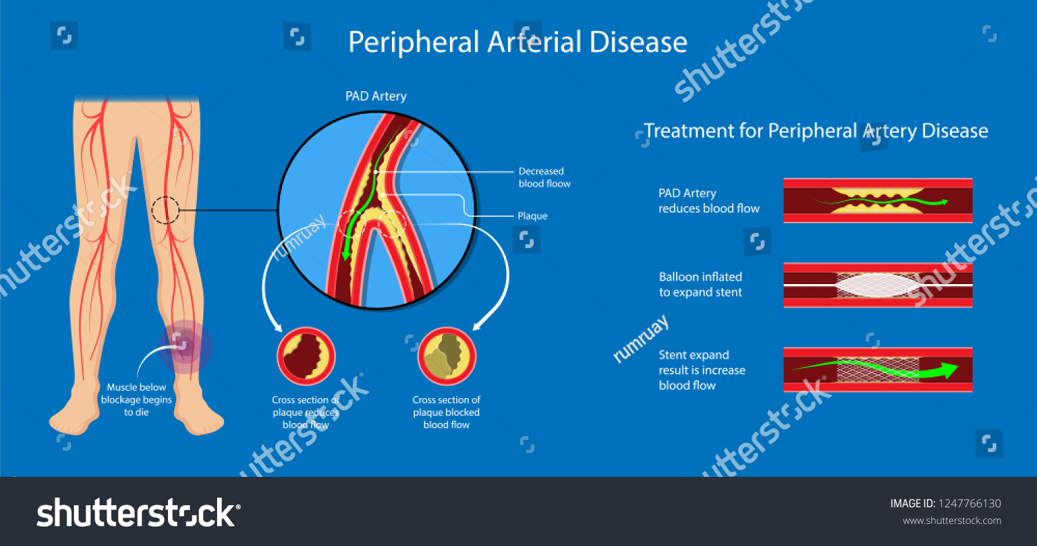 Peripheral Artery Disease Ankle Brachial Index Royalty Free Stock