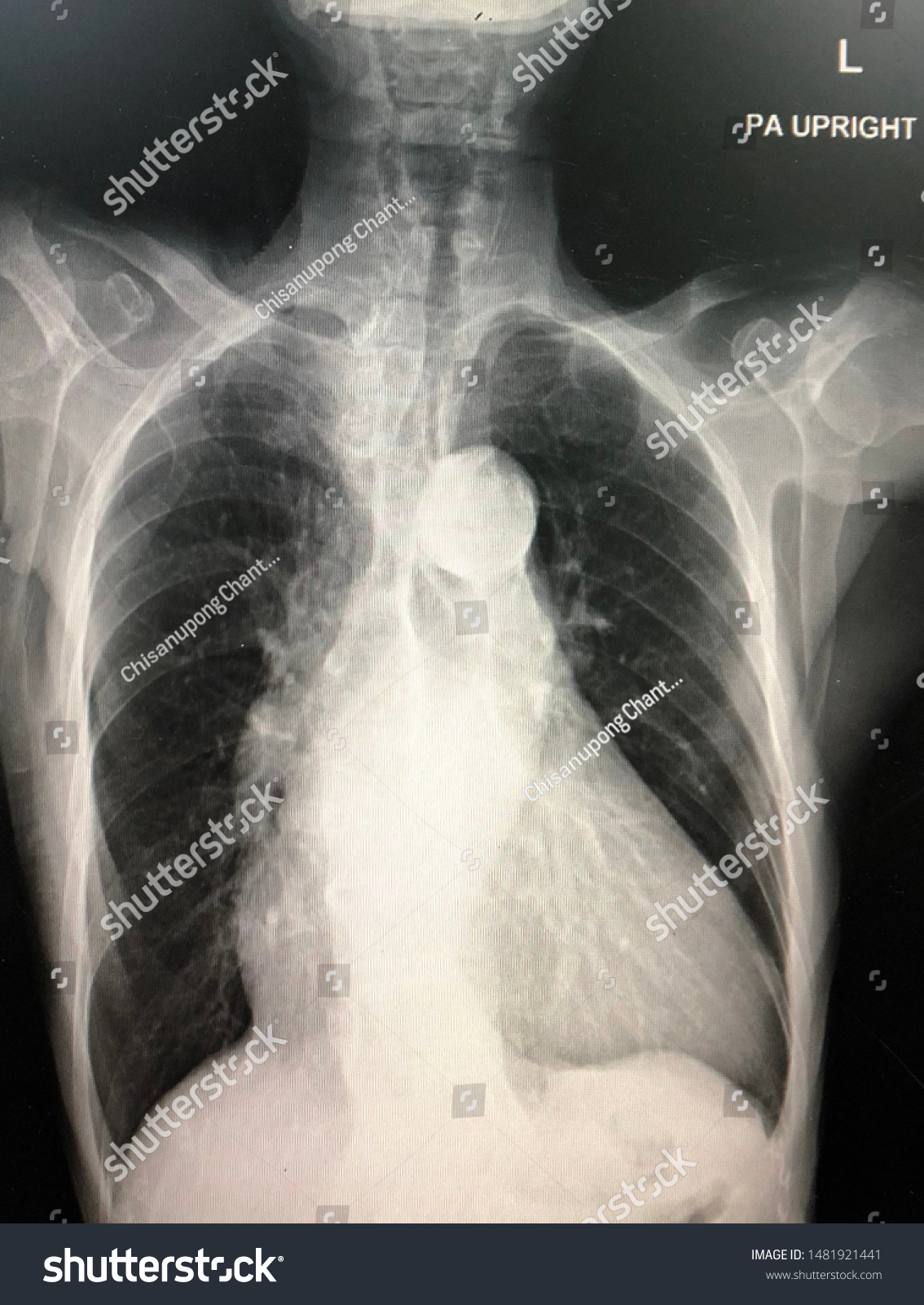 Chest X Ray Showed Cardiomegaly In COPD Patient Royalty Free Stock