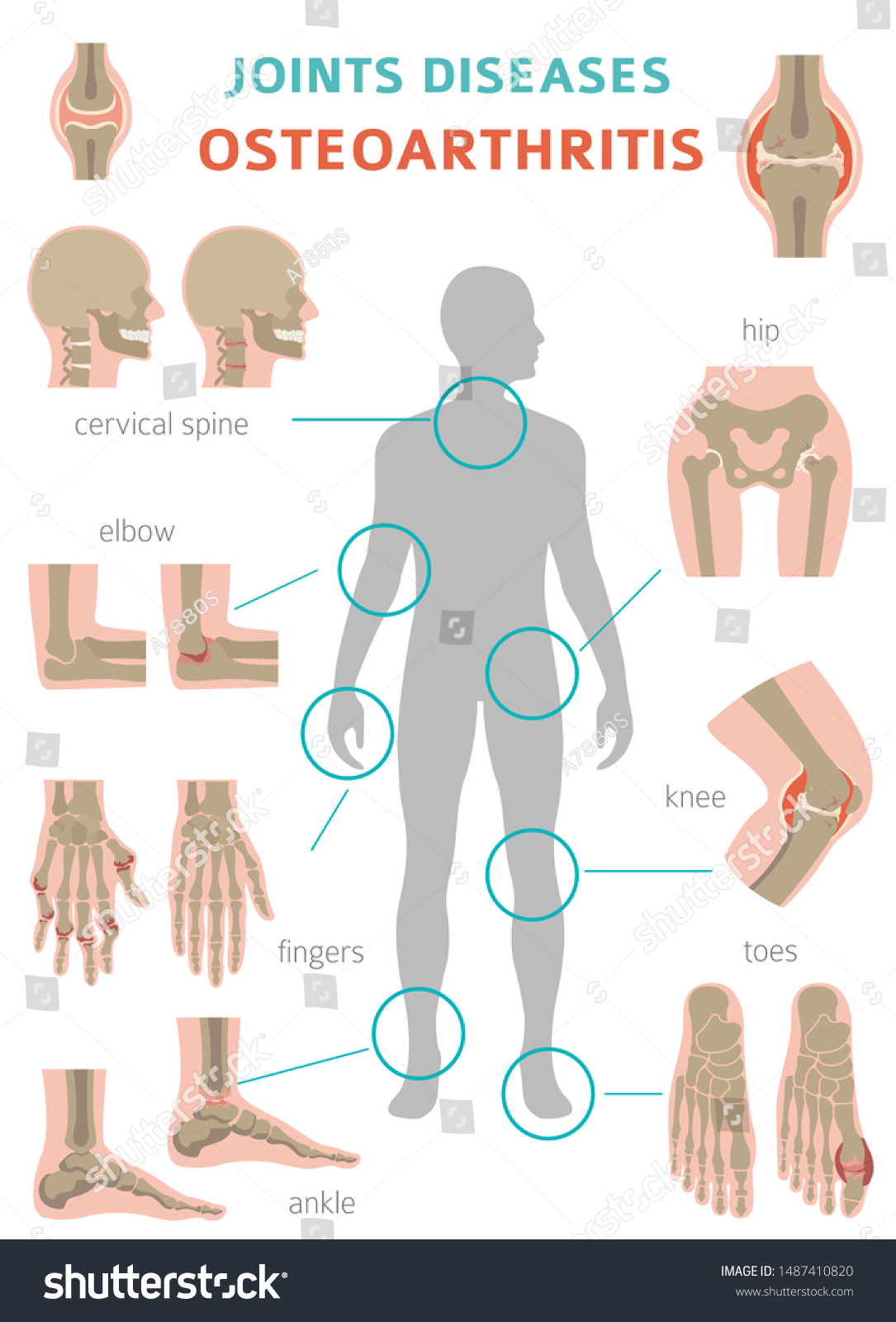 Arthritis Osteoarthritis Medical Infographic Royalty Free Stock