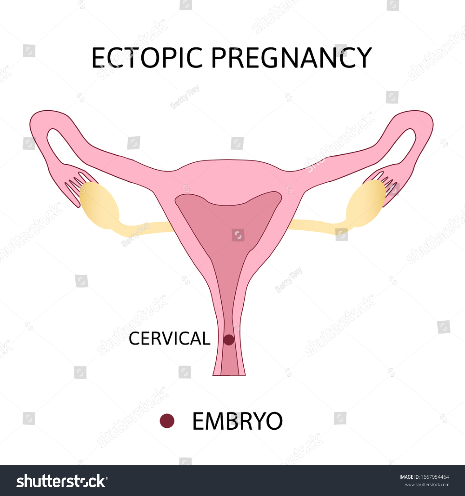 Ectopic Pregnancy Types Of Extra Uterine Royalty Free Stock Vector Avopix