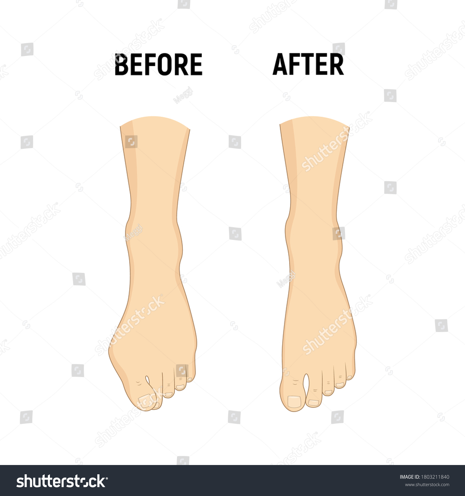 Hallux Valgus Mild Bunion Correction Vector Royalty Free Stock