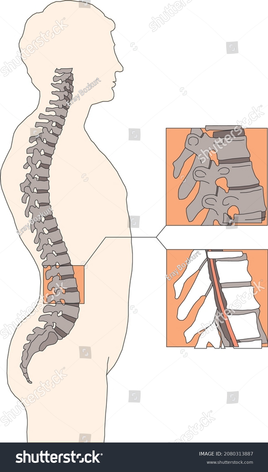 Spinal Deformity Flat Vector Illustration Royalty Free Stock Vector