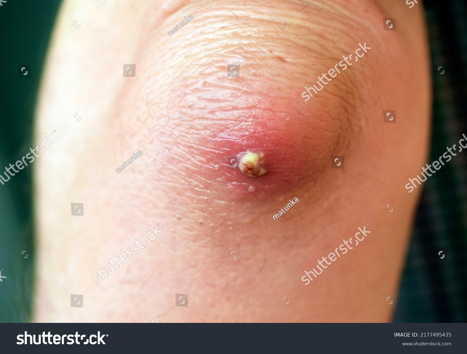 Olecranon Bursitis And Abscess At The Elbow Royalty Free Stock Photo