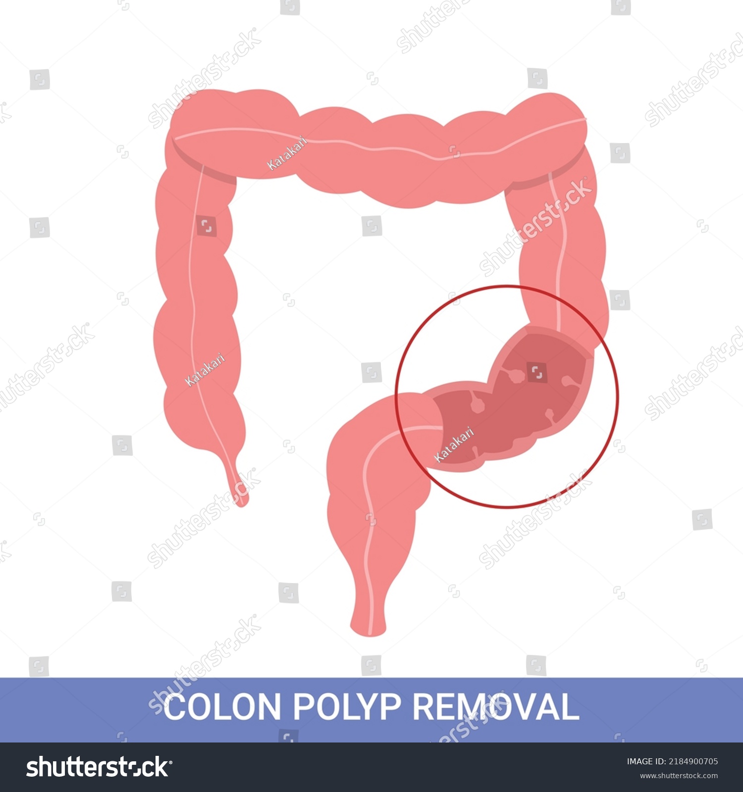 Colonoscopy Intestine Polypectomy Procedure Royalty Free Stock