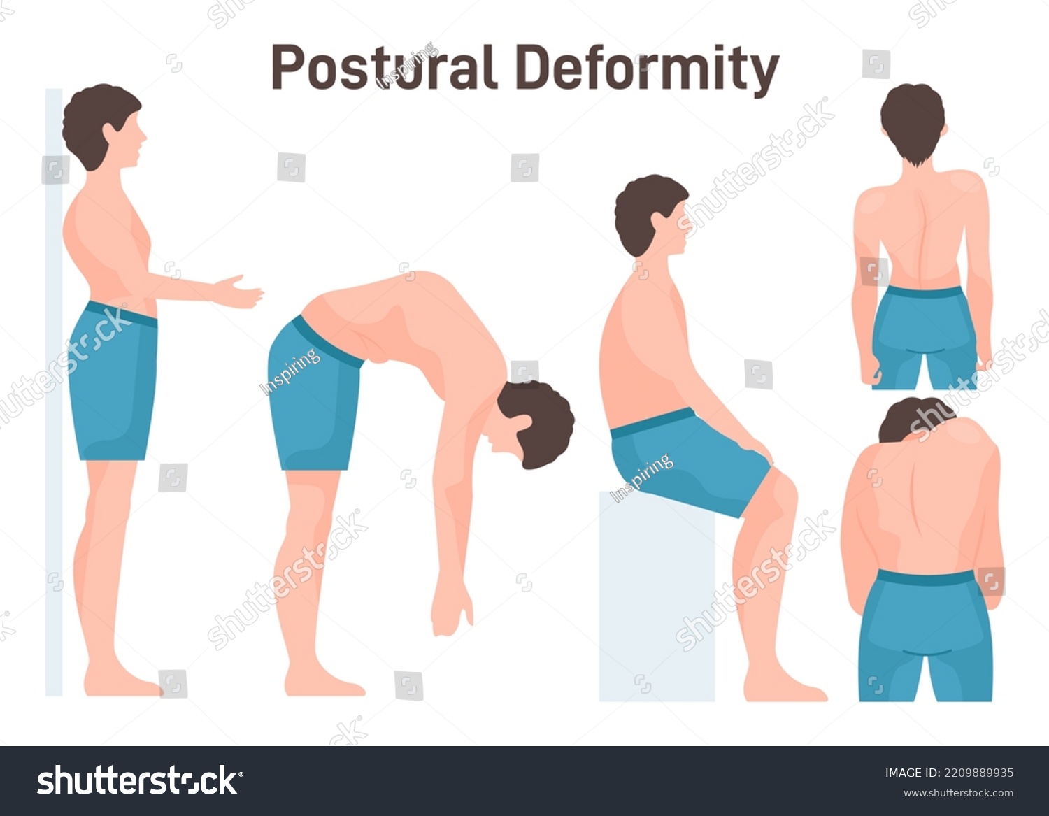 Postural Deformity Scoliosis Curvature Illness Royalty Free Stock