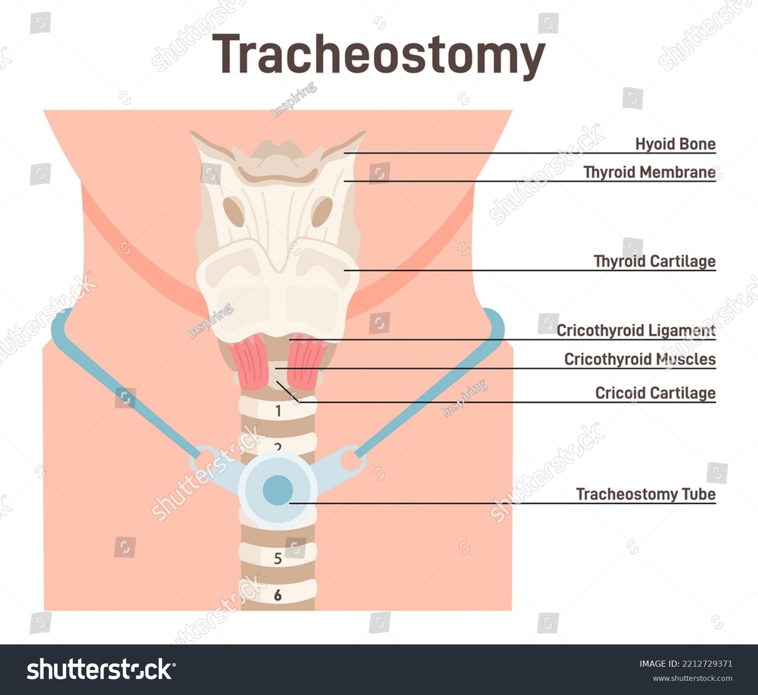 Tracheostomy Tracheal Surgery Neutralise Airway Royalty Free Stock